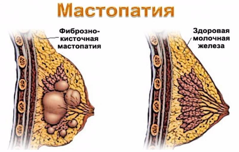 Что такое мастопатия молочных желез. Фиброзно-кистозная мастопатия классификация. Фиброзно-кистозная мастопатия молочных желез br-2. Мастопатия молочной железы что это такое лечение. Клинические проявления мастопатии.